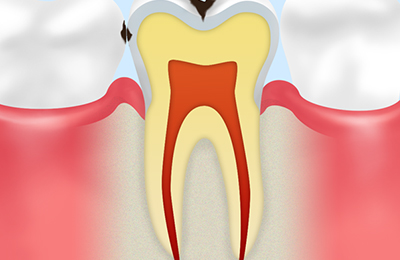 【エナメル質の虫歯】