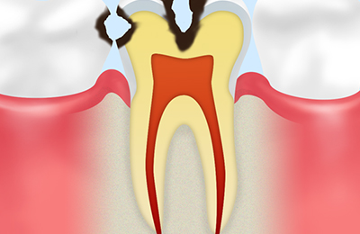 【象牙質の虫歯】