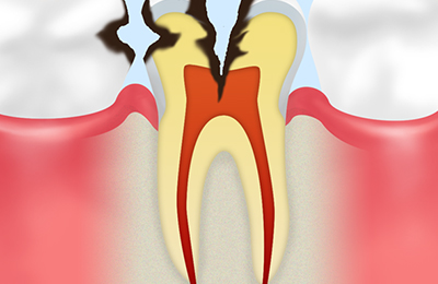 【神経まで達した虫歯】