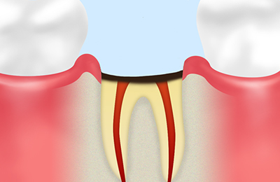 【歯根まで達した虫歯】