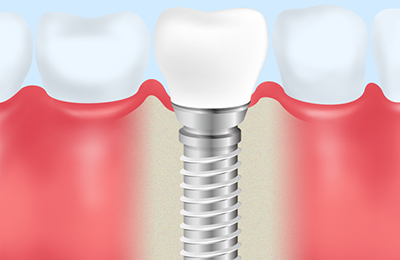 インプラント