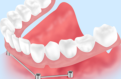 インプラントオーバーデンチャー