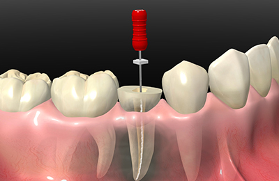 歯の根元の痛みを取り除き大切な歯を残す根管治療