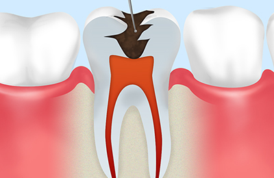虫歯・神経を徹底的に除去する