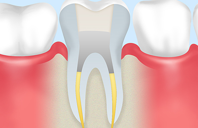 根管充填で細菌の侵入を防ぐ